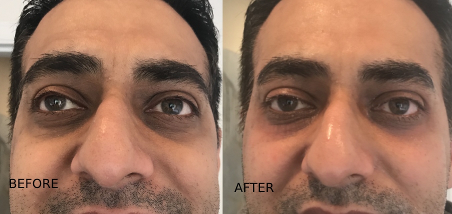 Treatment For Dark Circles Vancouver Incredible Results In One Session
