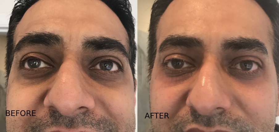 Laser Resurfacing Under Eye Dark Circles